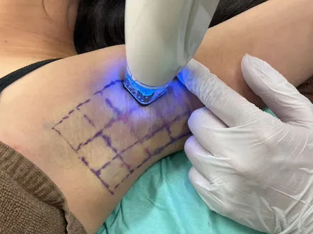 ビューホット照射