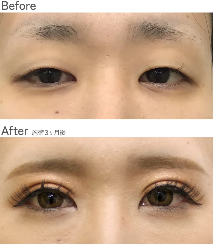 埋没法/マイクロカット法4点留め症例写真