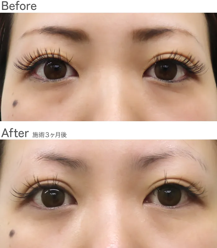 経結膜脱脂症例写真