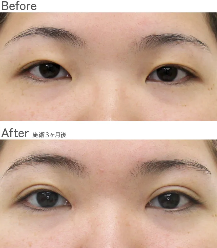 埋没法（マイクロカット4点留め）+目頭切開法+脂肪除去法症例写真