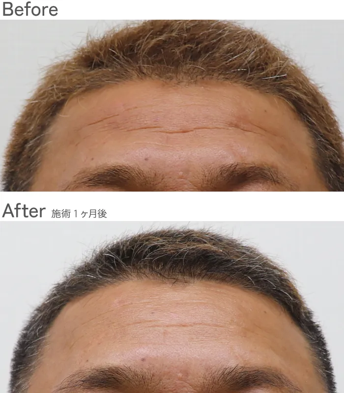 額ヒアルロン酸注射症例写真