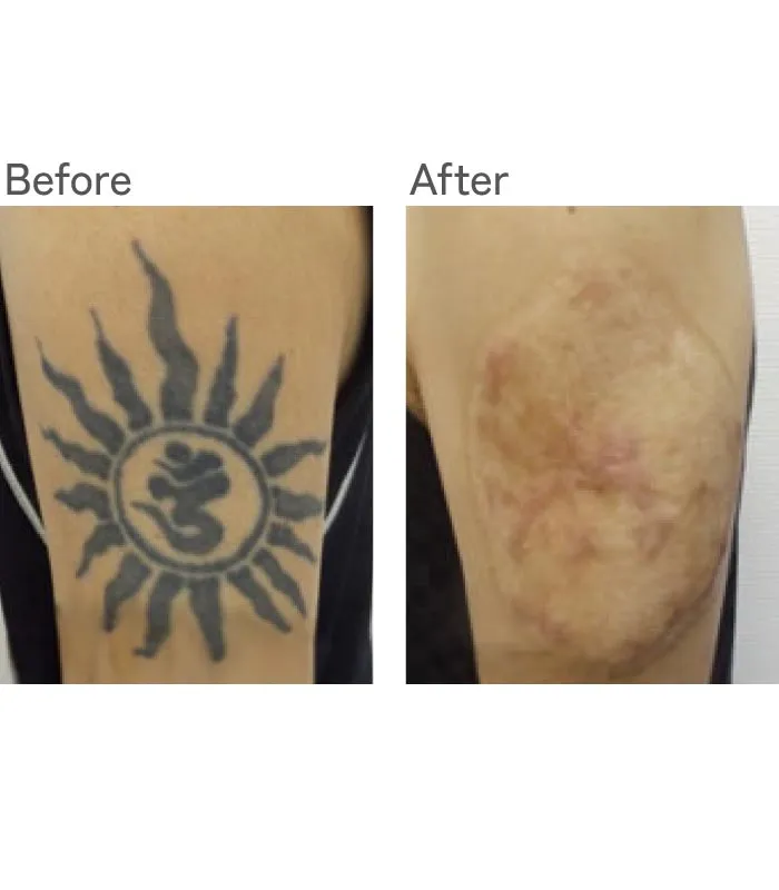 タトゥーリムーバー法症例写真
