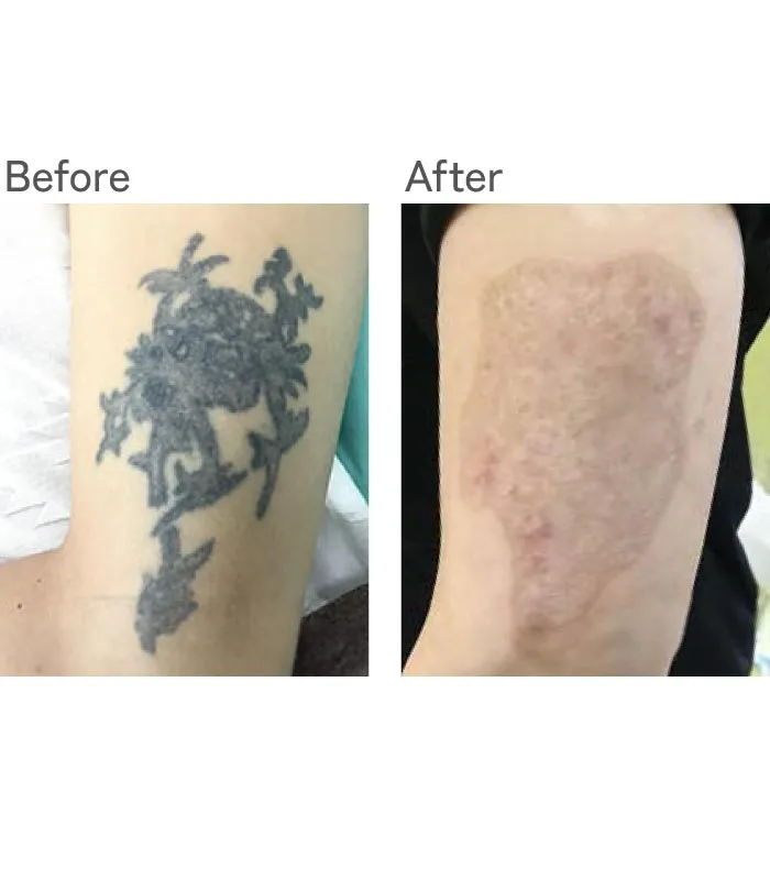 タトゥーリムーバー法症例写真