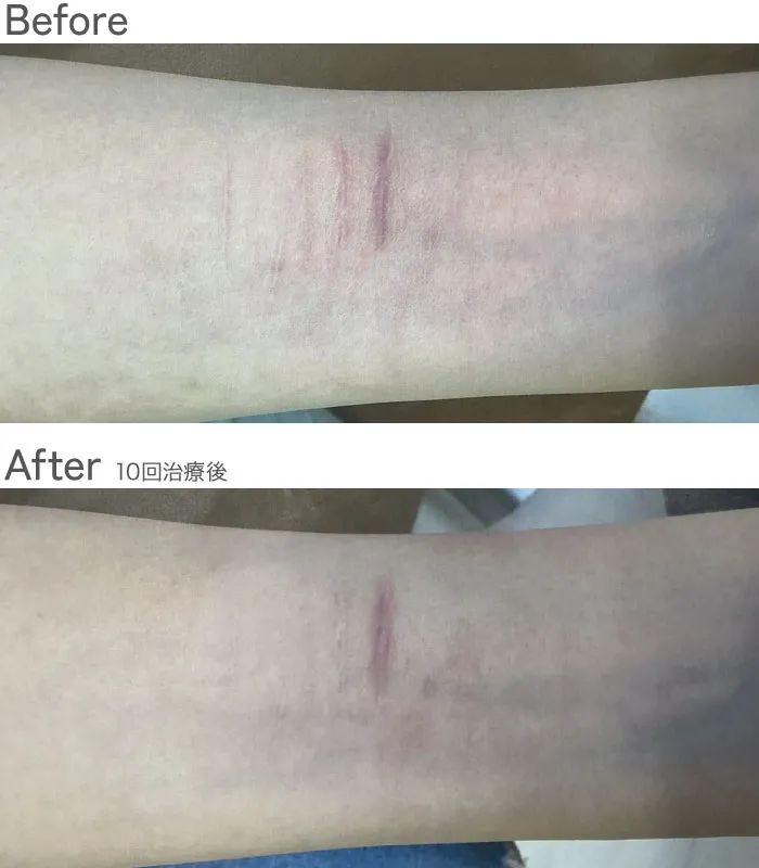 ダブルフラクショナルレーザー症例写真