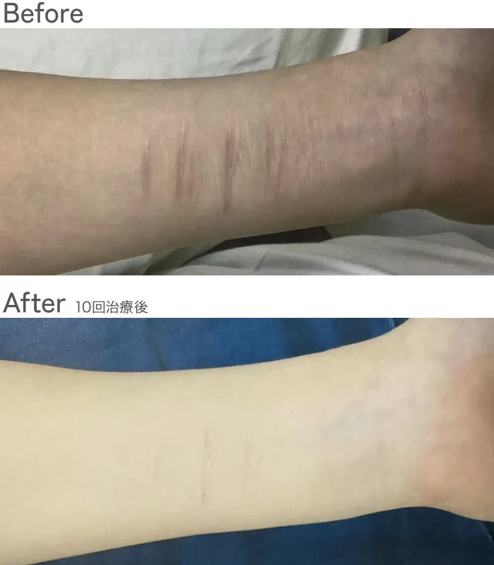 ダブルフラクショナルレーザー症例写真
