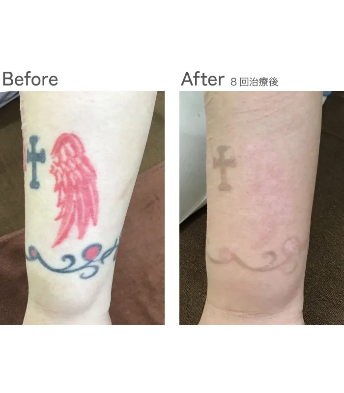 タトゥー除去ピコレーザー症例写真