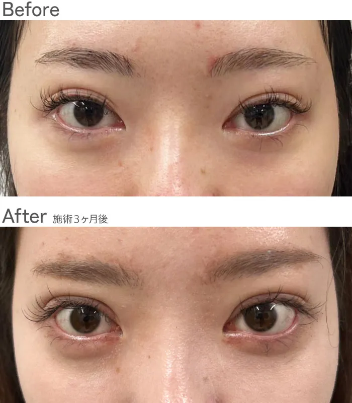 上眼瞼たるみとり+眼瞼下垂症例写真